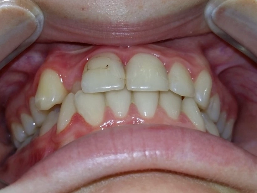 Зуб у неправильному положенні до лікування в S Vision Dental Clinic, Київ